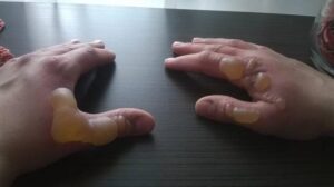 Oparzenie gazem LPG – jak skutecznie udzielić pierwszej pomocy i zadbać o bezpieczeństwo